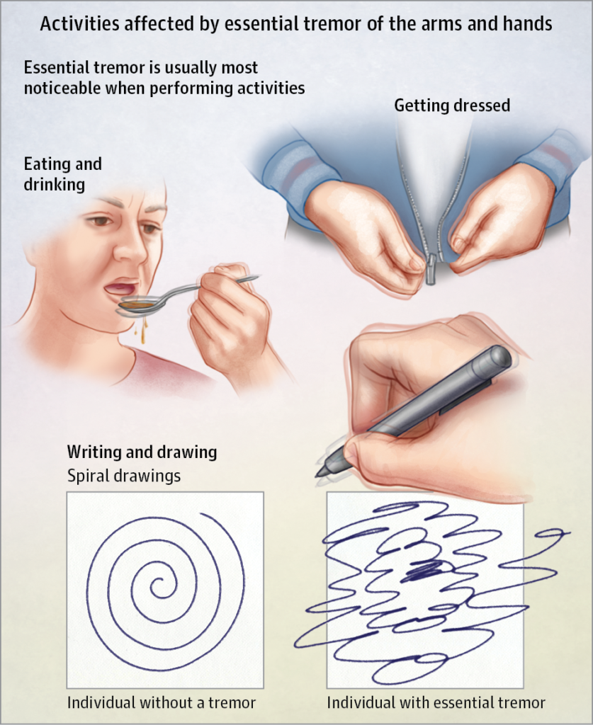 hand tremors, hand surgeon, birmingham, AL