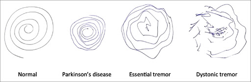 hand tremors, birmingham hand, essential tremor